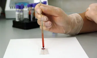 Blood Tests and Gynecomastia: A Detailed Approach