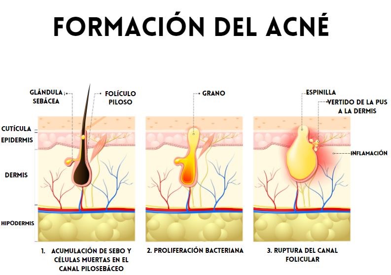 Acne2