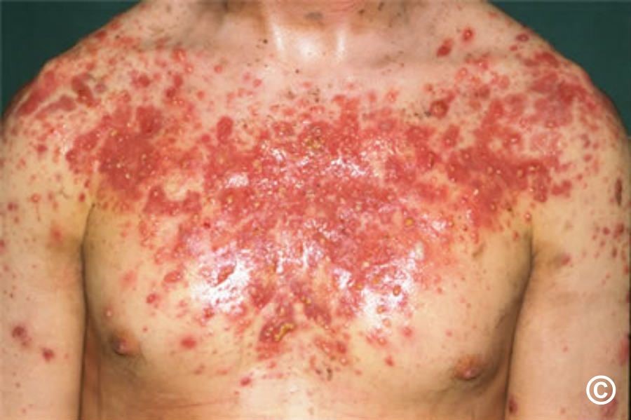 Acne5